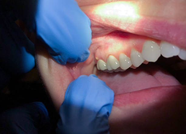 Best Knocked-Out Tooth (Avulsed Tooth) Treatment in Fox Lake, WI